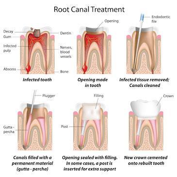 diagram of root canal treatment