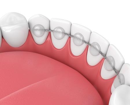 fixed retainer 