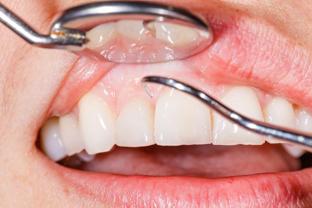 close up of gums being checked at dentist