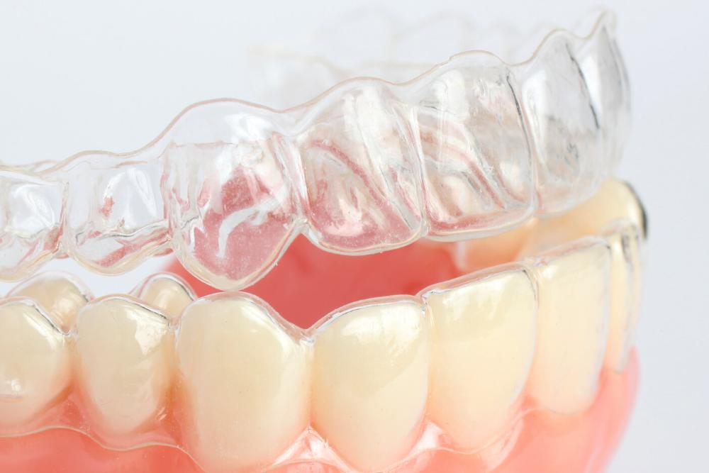 invisalign clear aligners from North York