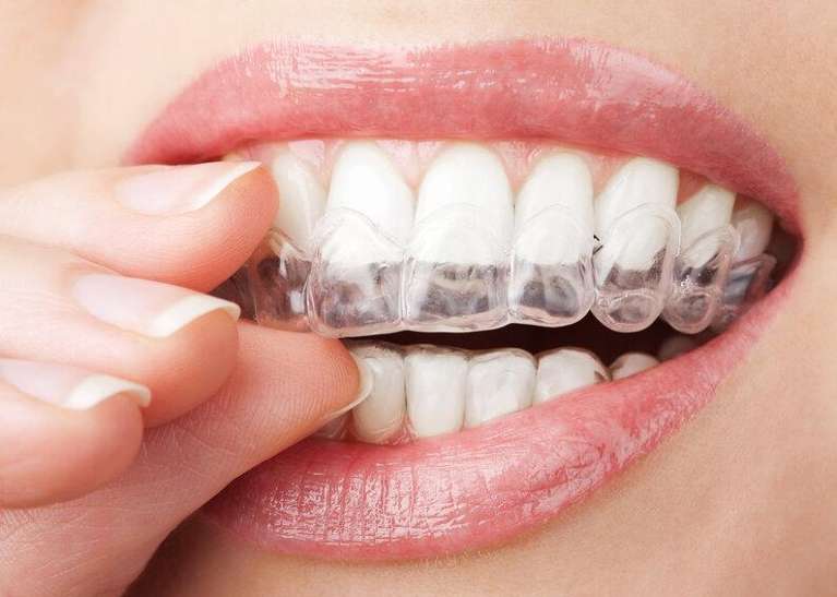close up of north york woman using invisalign